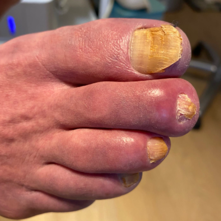 Kalknagels. Kalknagels behandelen. Schimmelnagels. Schimmelnagels behandelen.